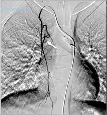 Videothoracoscopic management of hemoptysis due to anomalous bronchial vessel treated with multiple bronchial artery embolizations: a case report